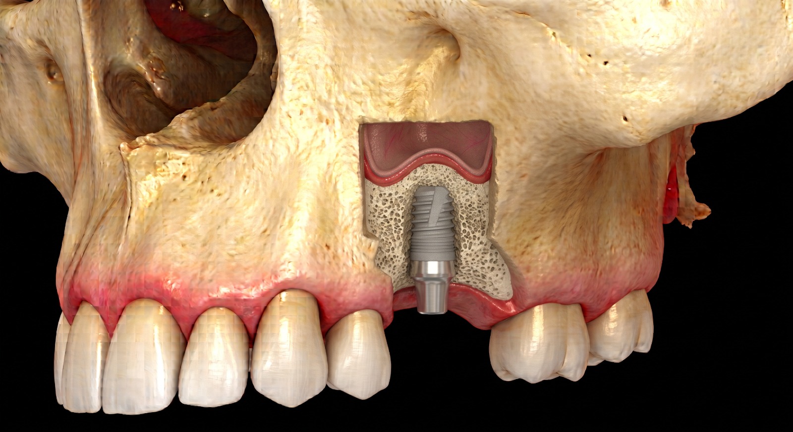 Step 4: a dental implant placed into the newly formed bone within the grafted sinus